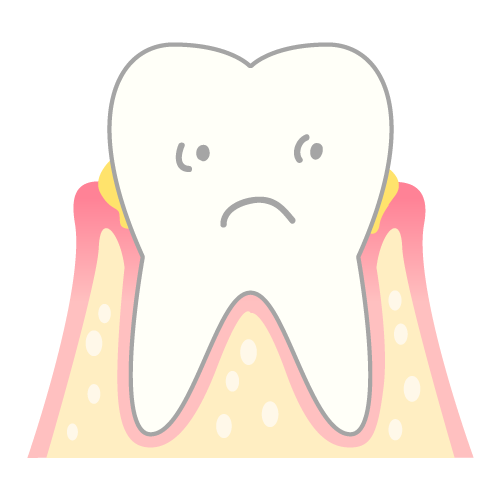 periodontosis_mechanism02